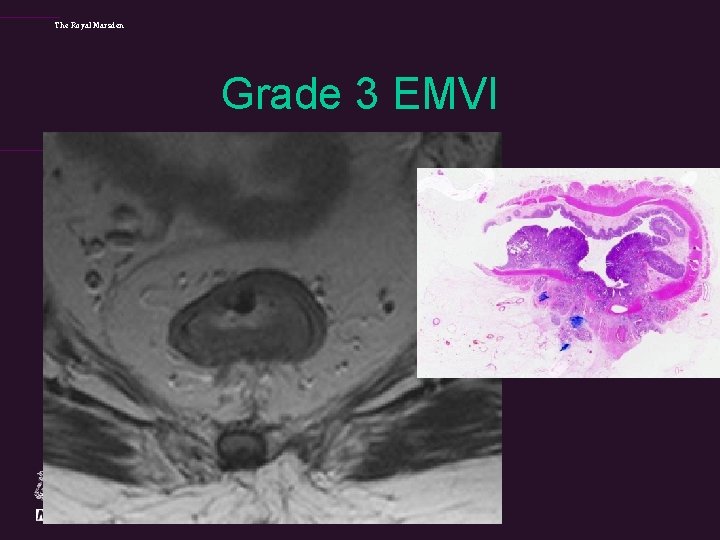 The Royal Marsden Grade 3 EMVI 