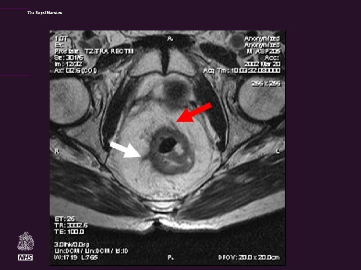 The Royal Marsden Grade 3 EMVI 