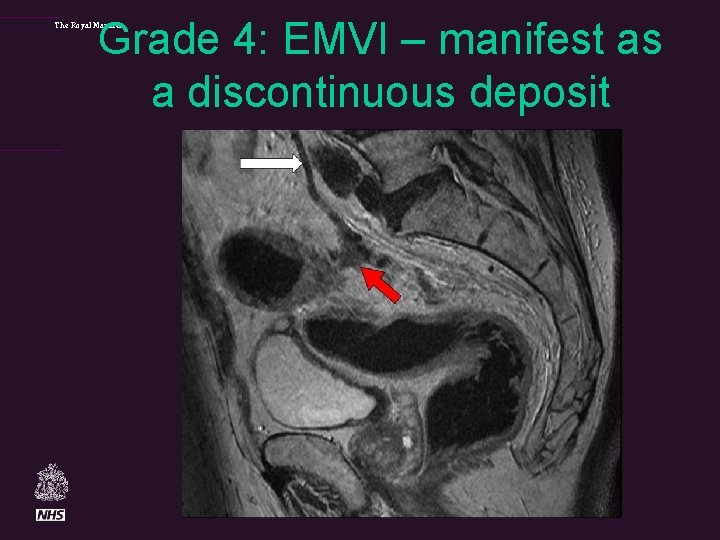 Grade 4: EMVI – manifest as a discontinuous deposit The Royal Marsden 