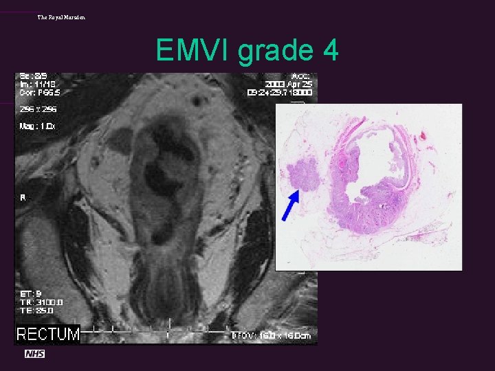 The Royal Marsden EMVI grade 4 