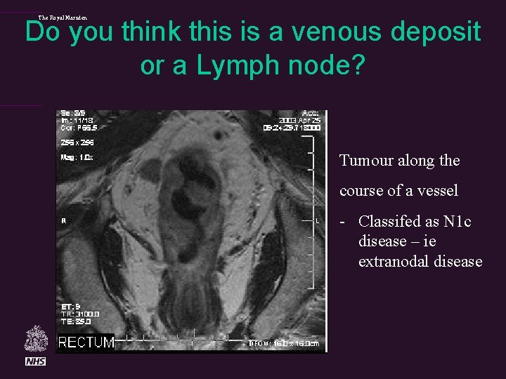 The Royal Marsden Do you think this is a venous deposit or a Lymph