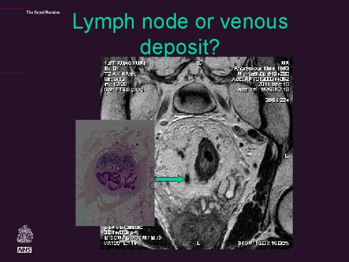 The Royal Marsden Lymph node or venous deposit? 