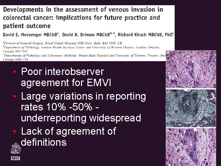 The Royal Marsden • Poor interobserver agreement for EMVI • Large variations in reporting