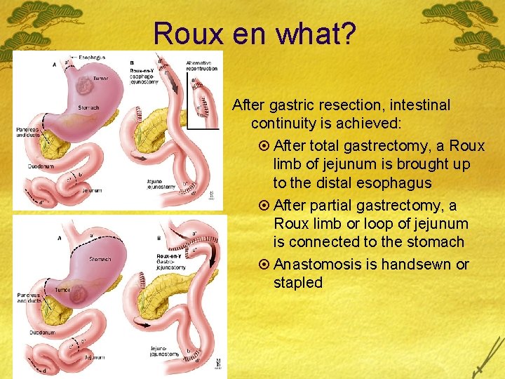 Roux en what? After gastric resection, intestinal continuity is achieved: ¤ After total gastrectomy,