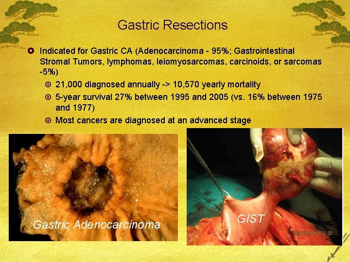 Gastric Resections £ Indicated for Gastric CA (Adenocarcinoma - 95%; Gastrointestinal Stromal Tumors, lymphomas,