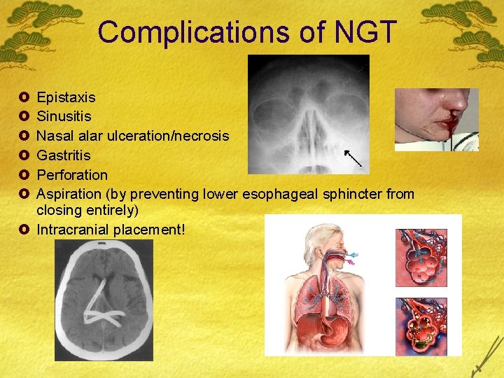 Complications of NGT £ £ £ Epistaxis Sinusitis Nasal alar ulceration/necrosis Gastritis Perforation Aspiration