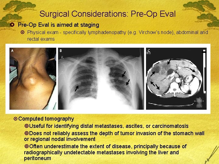 Surgical Considerations: Pre-Op Eval £ Pre-Op Eval is aimed at staging ¤ Physical exam