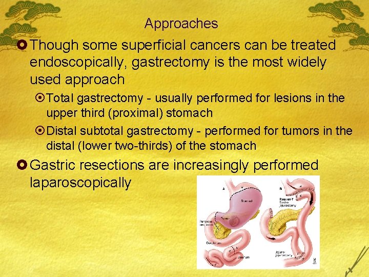 Approaches £ Though some superficial cancers can be treated endoscopically, gastrectomy is the most