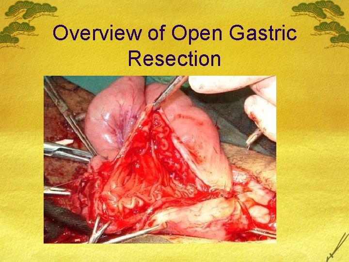 Overview of Open Gastric Resection 