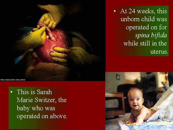  • At 24 weeks, this unborn child was operated on for spina bifida