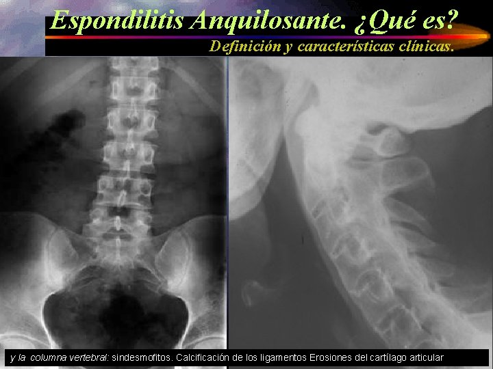Espondilitis Anquilosante. ¿Qué es? Definición y características clínicas. y la columna vertebral: sindesmofitos. Calcificación