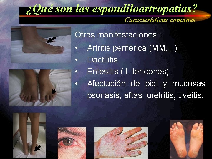 ¿Qué son las espondiloartropatias? Características comunes Otras manifestaciones : • • Artritis periférica (MM.