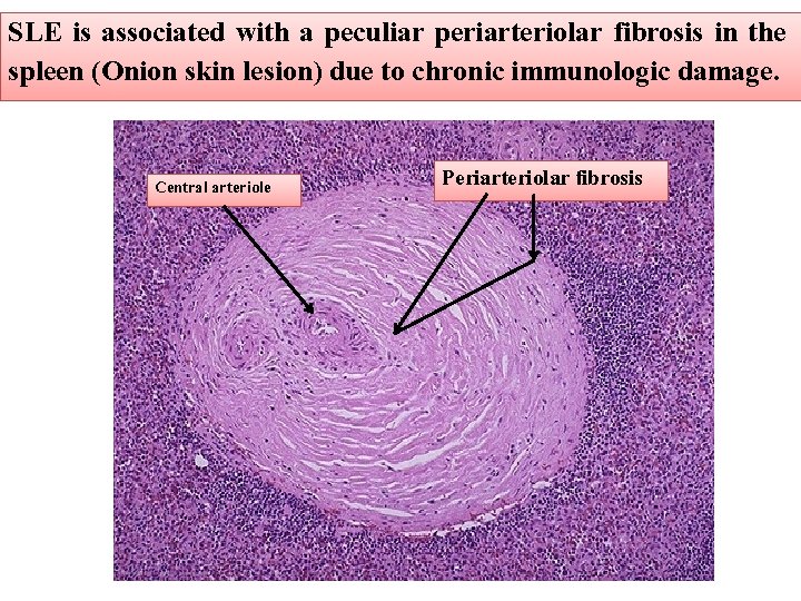 SLE is associated with a peculiar periarteriolar fibrosis in the spleen (Onion skin lesion)