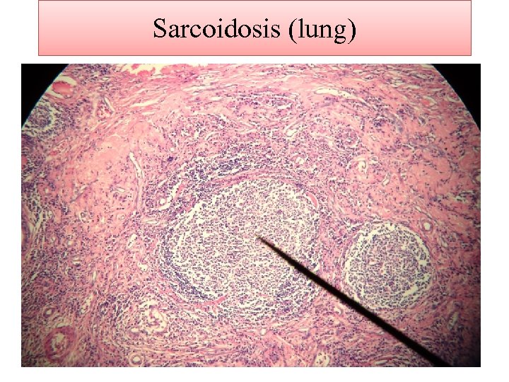 Sarcoidosis (lung) 