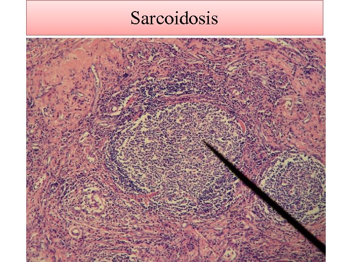 Sarcoidosis 