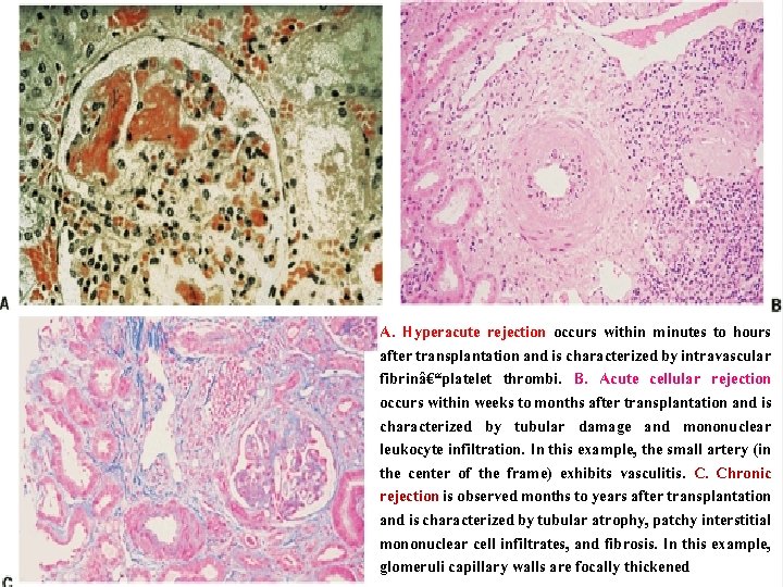 A. Hyperacute rejection occurs within minutes to hours after transplantation and is characterized by