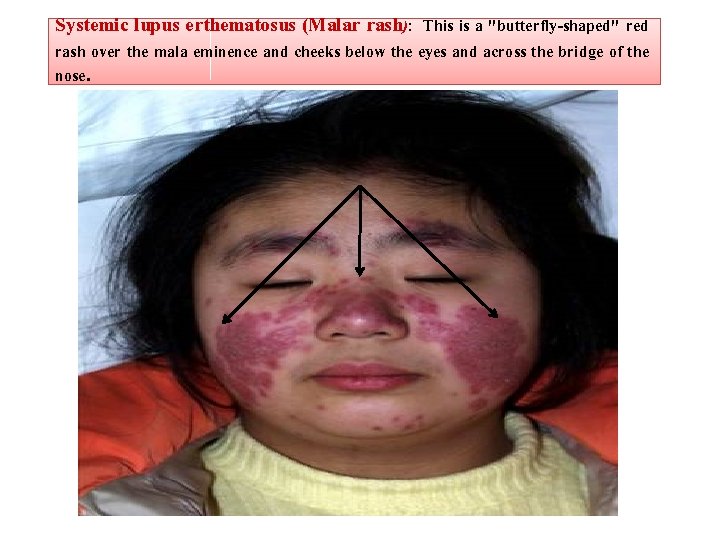 Systemic lupus erthematosus (Malar rash): This is a "butterfly-shaped" red rash over the mala