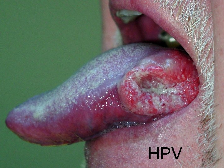 HPV HPV