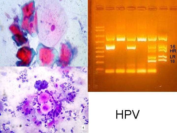 HPV 16 HR LR 18 HPV 16 HR LR 18