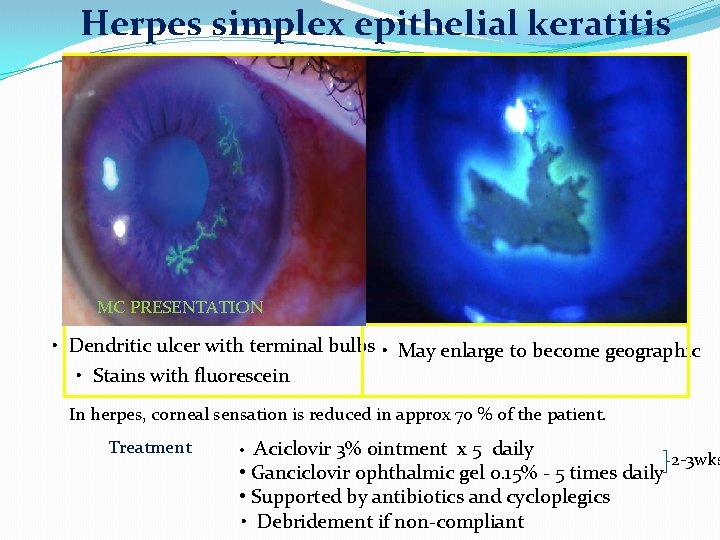 Herpes simplex epithelial keratitis MC PRESENTATION • Dendritic ulcer with terminal bulbs • May