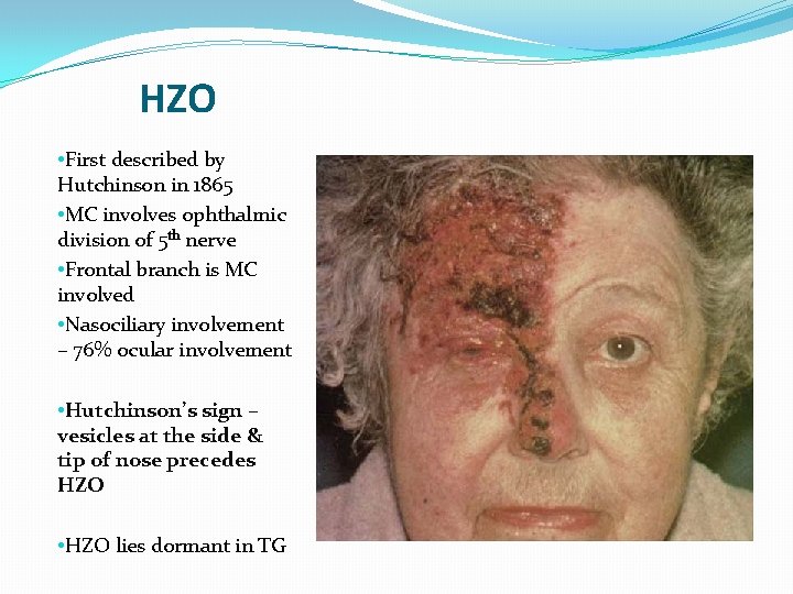 HZO • First described by Hutchinson in 1865 • MC involves ophthalmic division of