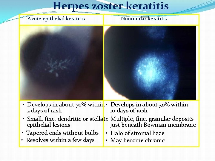 Herpes zoster keratitis Acute epithelial keratitis Nummular keratitis • Develops in about 50% within