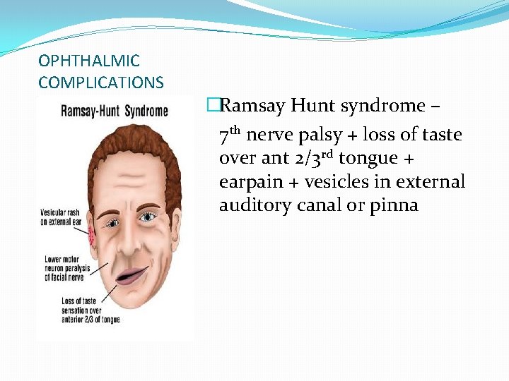 OPHTHALMIC COMPLICATIONS �Ramsay Hunt syndrome – 7 th nerve palsy + loss of taste