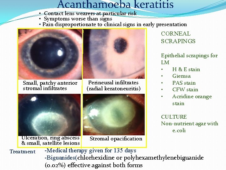 Acanthamoeba keratitis • Contact lens wearers at particular risk • Symptoms worse than signs