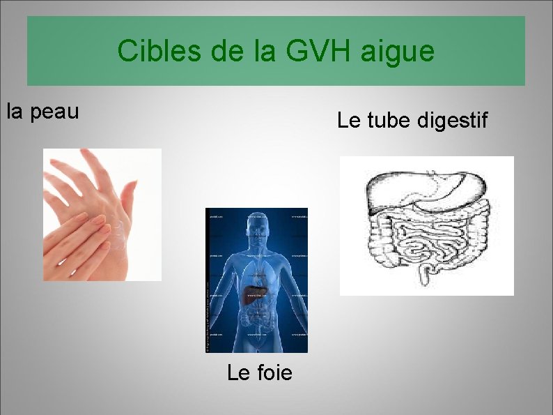 Cibles de la GVH aigue la peau Le tube digestif Le foie 