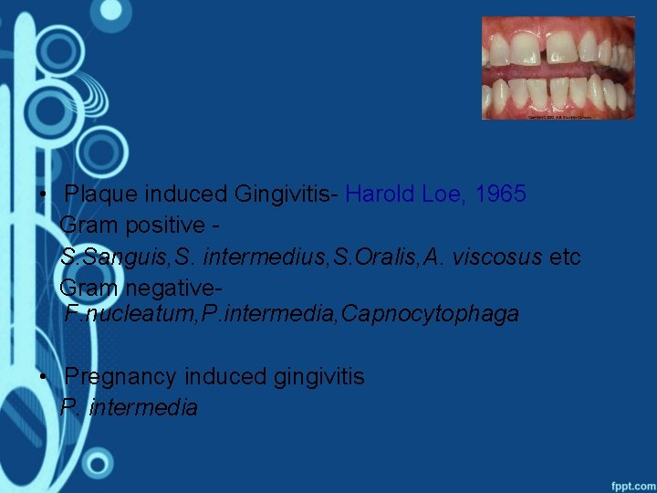  • Plaque induced Gingivitis- Harold Loe, 1965 Gram positive S. Sanguis, S. intermedius,