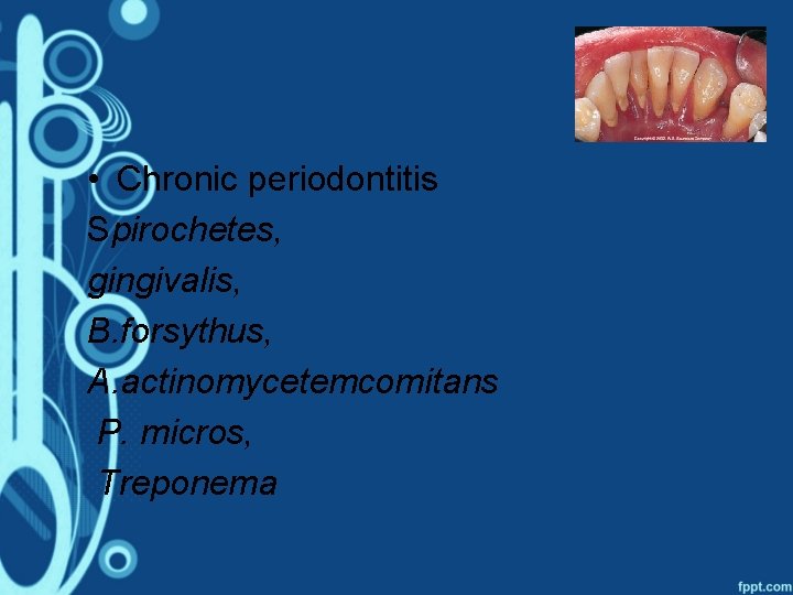  • Chronic periodontitis Spirochetes, gingivalis, B. forsythus, A. actinomycetemcomitans P. micros, Treponema 