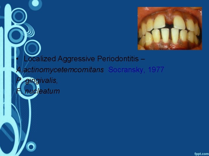  • Localized Aggressive Periodontitis – A. actinomycetemcomitans Socransky, 1977 P. gingivalis, F. nucleatum