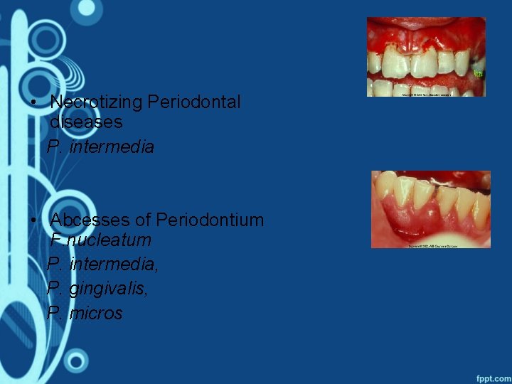  • Necrotizing Periodontal diseases P. intermedia • Abcesses of Periodontium F. nucleatum P.