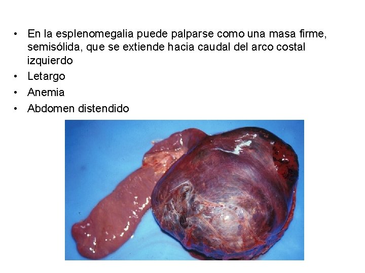  • En la esplenomegalia puede palparse como una masa firme, semisólida, que se