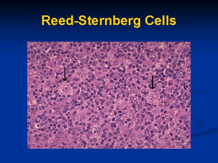 Reed-Sternberg Cells 