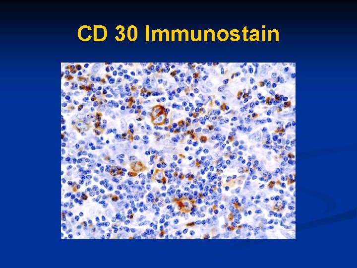 CD 30 Immunostain 