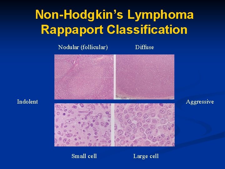 Non-Hodgkin’s Lymphoma Rappaport Classification Nodular (follicular) Diffuse Indolent Aggressive Small cell Large cell 