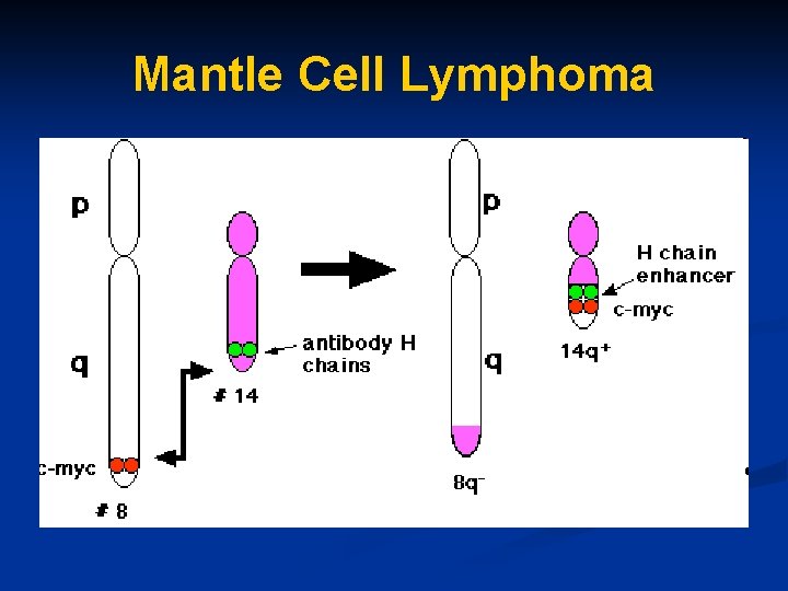 Mantle Cell Lymphoma 