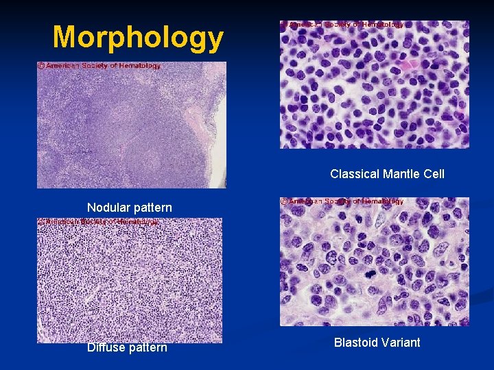 Morphology Classical Mantle Cell Nodular pattern Diffuse pattern Blastoid Variant 