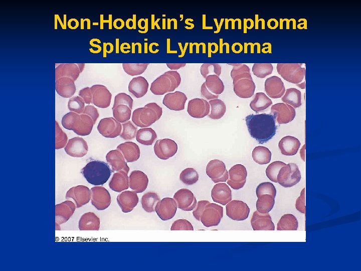 Non-Hodgkin’s Lymphoma Splenic Lymphoma 