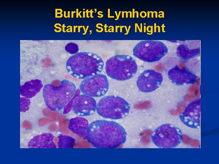 Burkitt’s Lymhoma Starry, Starry Night 