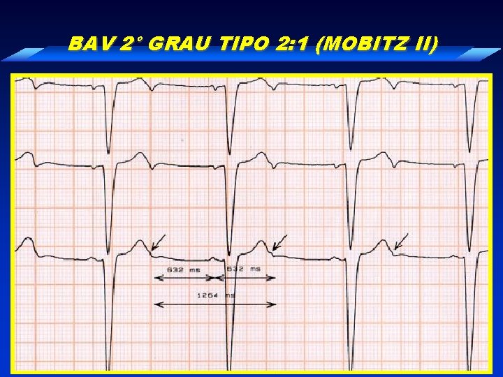 BAV 2° GRAU TIPO 2: 1 (MOBITZ II) 