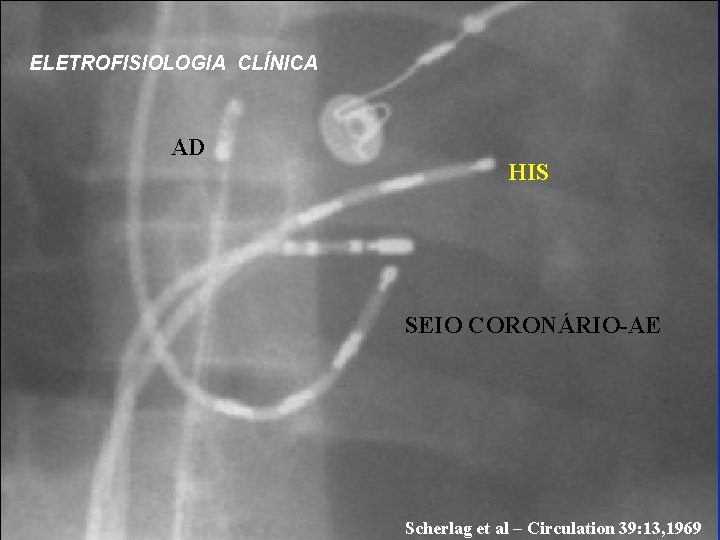 ELETROFISIOLOGIA CLÍNICA AD HIS SEIO CORONÁRIO-AE Scherlag et al – Circulation 39: 13, 1969