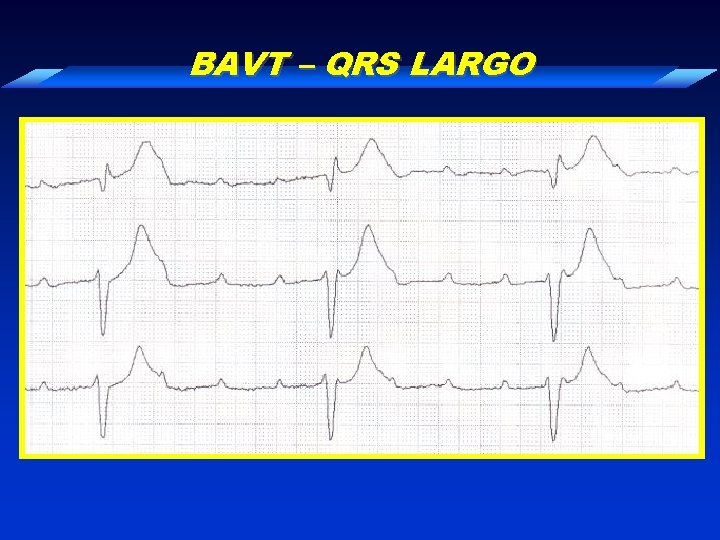 BAVT – QRS LARGO 