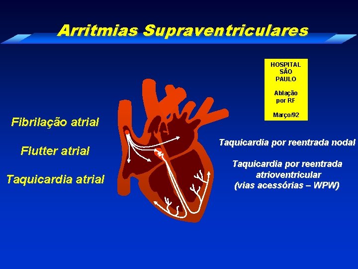 Arritmias Supraventriculares HOSPITAL SÃO PAULO Ablação por RF Fibrilação atrial Flutter atrial Taquicardia atrial