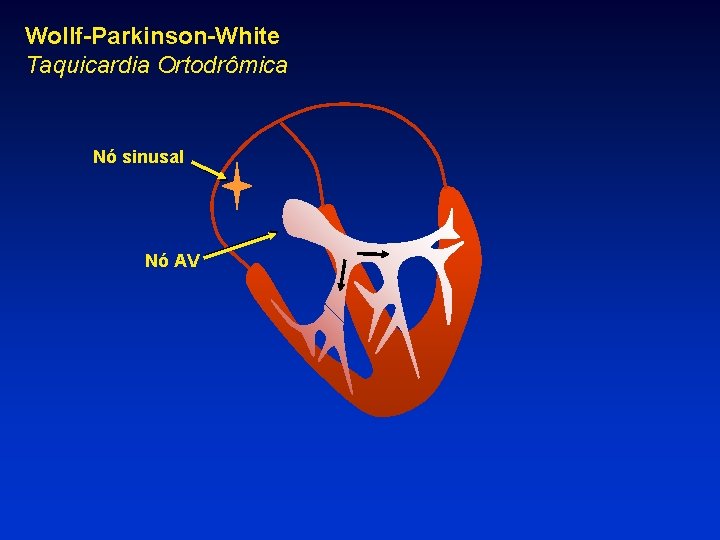 Wollf-Parkinson-White Taquicardia Ortodrômica Nó sinusal Nó AV 