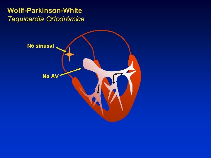 Wollf-Parkinson-White Taquicardia Ortodrômica Nó sinusal Nó AV 