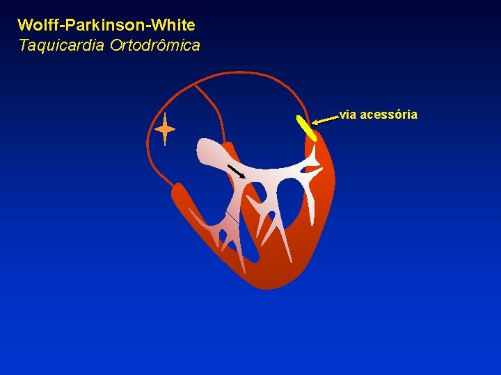 Wolff-Parkinson-White Taquicardia Ortodrômica via acessória 