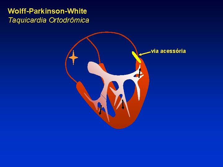 Wolff-Parkinson-White Taquicardia Ortodrômica via acessória 