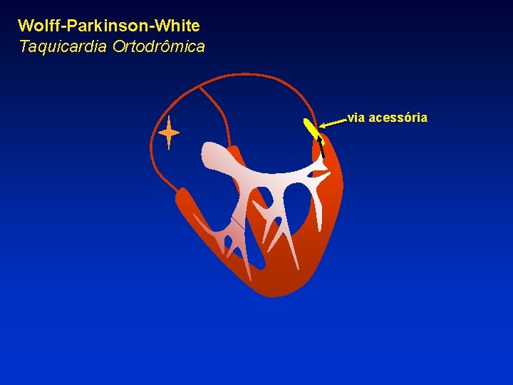 Wolff-Parkinson-White Taquicardia Ortodrômica via acessória 